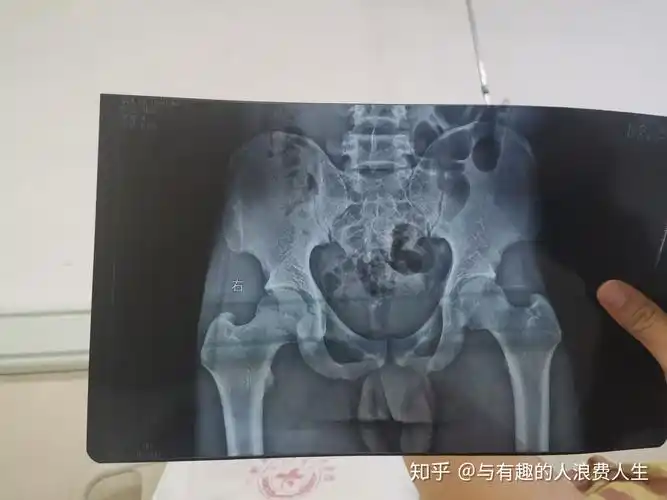 20岁有骶髂关节炎和轻微腰突病症请问这种情况如何做是正确的