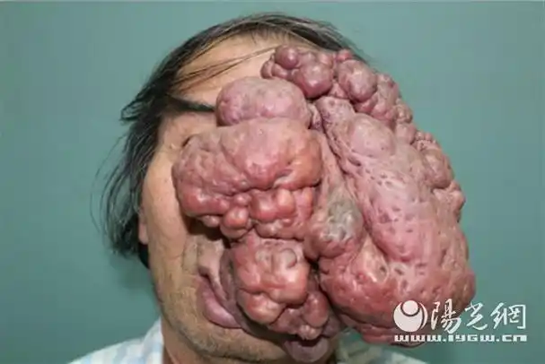 被脸上3.5公斤的肿瘤困扰了30年 患者李先生历经5年12次手术换新颜