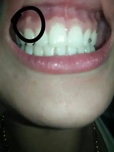 牙龈上有个白色硬包,不痛不痒