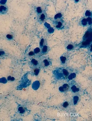 东科老师推荐的抗酸染色(热染法)小妙招