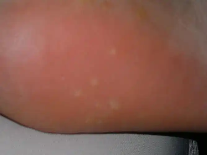 脚底长了很多黄豆大小的透明色硬泡,是鸡眼吗?不是的话,又是什么东西?