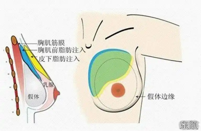 【美然】定制你的"峰"景——放心拥有傲人曲线 | 科普篇