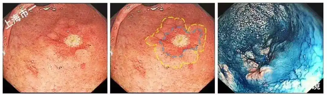 4个精彩病例带你了解早期胃癌有图有真相