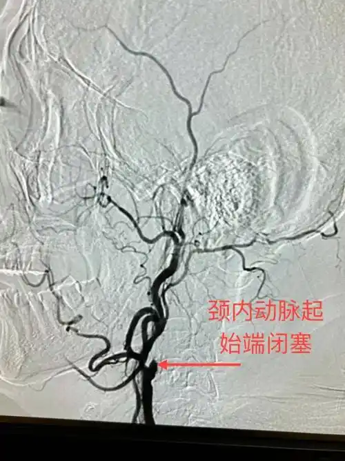 两例高难度介入取栓手术 高效打通患者"生命通道"_血管_治疗_团队