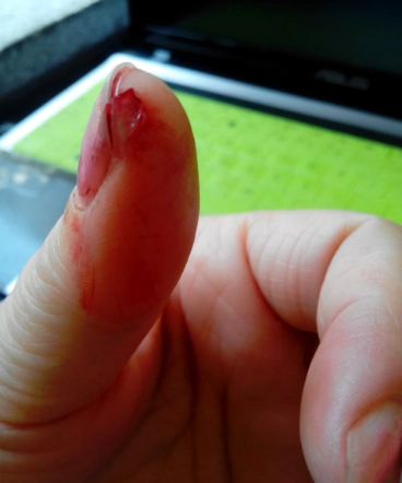 手出血的图片61