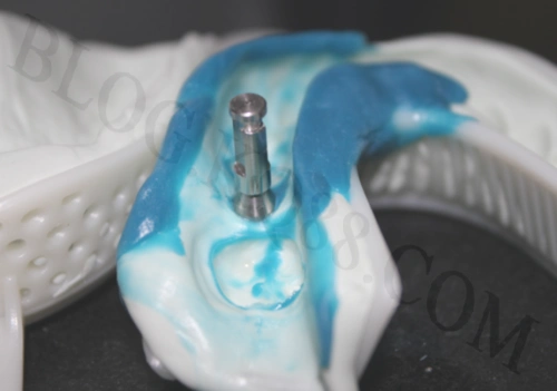 将种植体替代体与印模帽链接.交技工室制作.取模型.