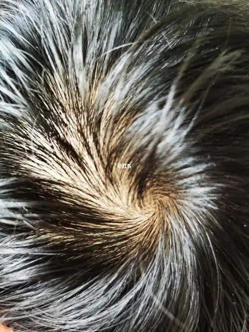 治疗前和治疗后头旋和发际线对比