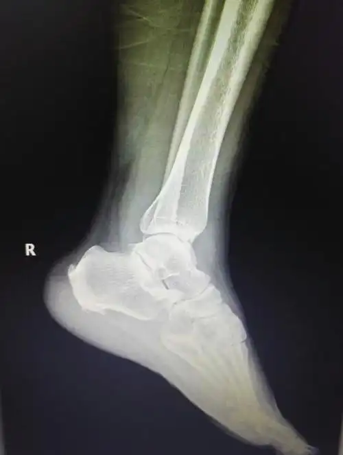 术前x线片显示跟骨增生骨刺明显.