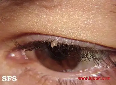 丝状疣  :皮一细长丝状突起.好发于眼睑,颈项,颏部和头皮等部位.