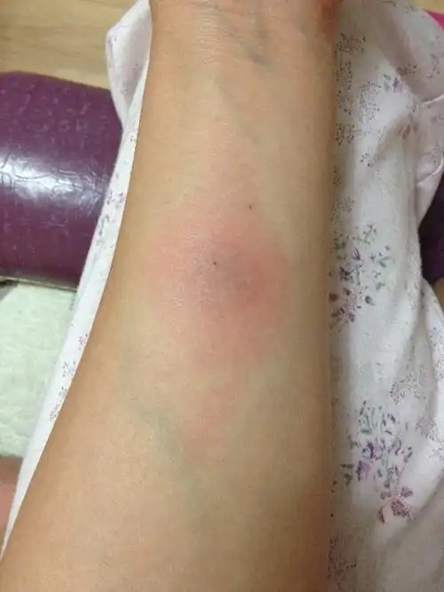 [试管婴儿]有做过ppd实验结果强阳的姐妹吗?怎么治疗的?