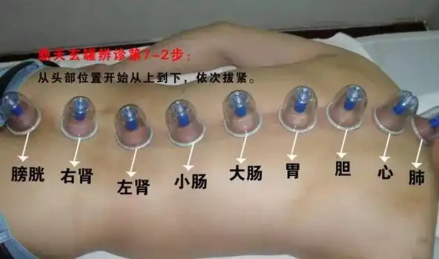 军医提醒:拔火罐后的罐印反映什么问题