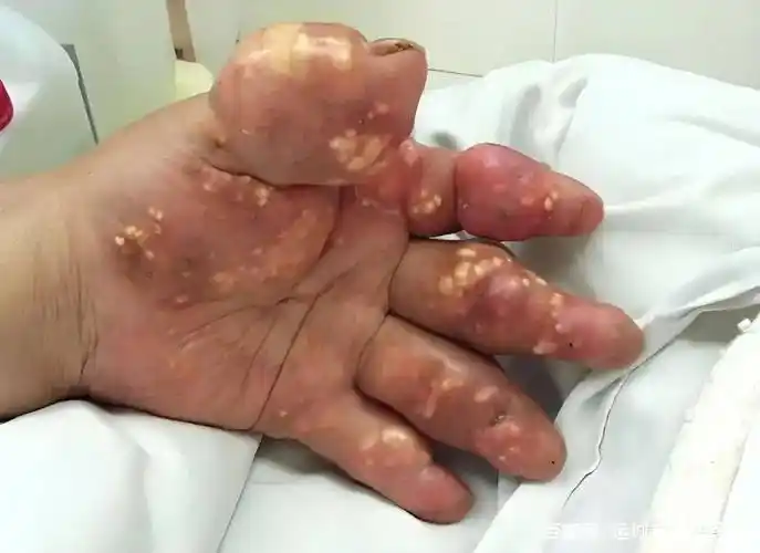 高尿酸检查要趁早,带你了解皮下痛风石!