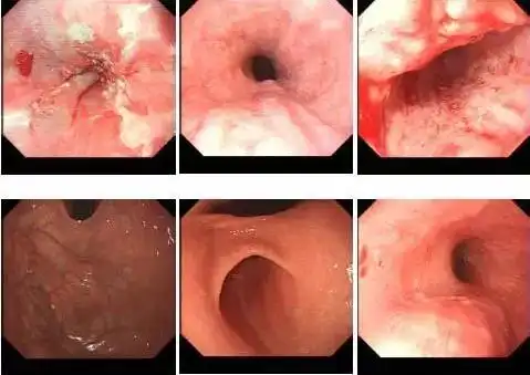 得了食管癌却又查出心脏肿瘤,古稀老人命悬一线,怎么破?