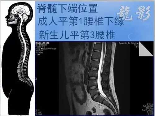 核磁共振和脊柱解剖