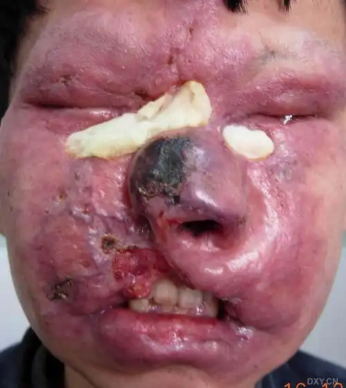 【病例讨论】疑难皮肤病:鼻面部浸润性红斑,溃疡,坏死,不痛不痒1年余