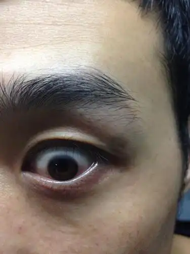 角膜上面浑浊了,严重吗?求解是什么原因?要紧不?