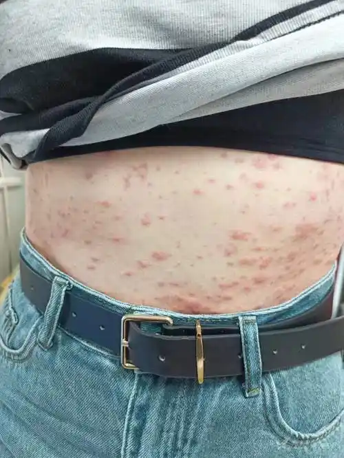 颈躯干红斑丘疱疹3天经治疗后加重