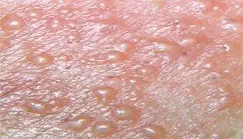 淋病的症状及淋病并发症 淋病对患者不良影响-精准抗艾-互联网艾滋病