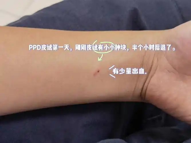 ppd阴性过程记录