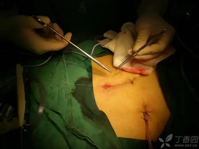 腹部缝合经验之腹壁的间断皮下缝合,可以免拆线!