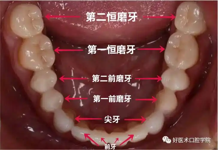 第二恒磨牙也需要做窝沟封闭哦06什么情况不能做窝沟封闭?