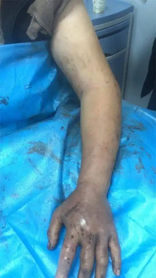 利川今年80多人被蛇咬就医!