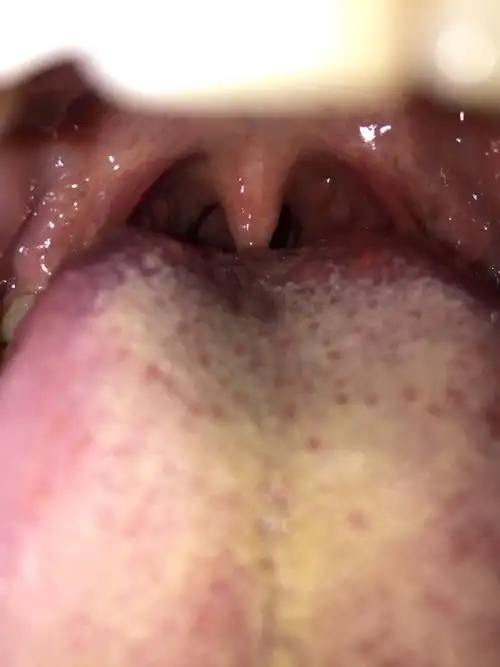 舌头根部这些疙瘩是正常的嘛?