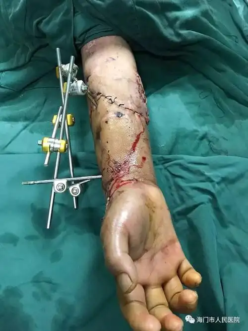 可怕当右手臂皮肤被机器严重绞坏手还能保住吗