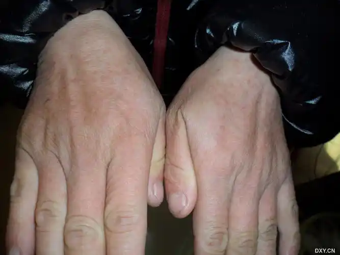 【病例讨论】掌跖点状角化症手背面也会有皮疹么?