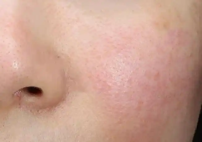 你是敏感肌吗美容师说这样护理很好