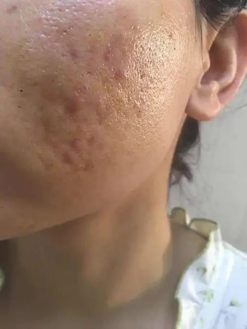 严重烂脸痘痘肌,1年多的经验.
