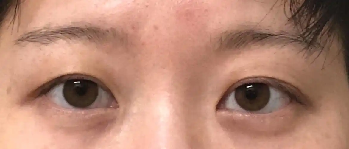 长时间戴眼镜引起眼睛的变形这该怎么矫正