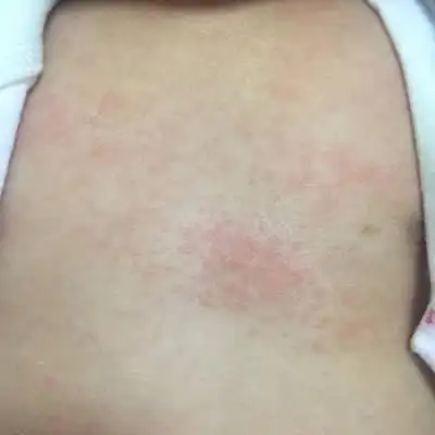 宝宝身上长了很多疹子,如图,有没有宝妈遇到过?