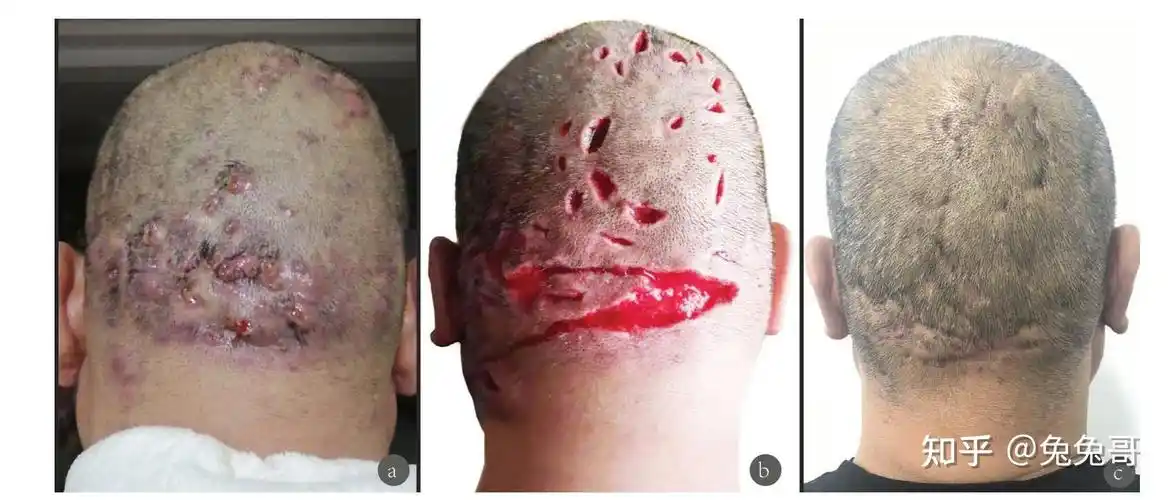 去顶开窗术和切开引流术治疗头部脓肿性穿掘性毛囊周围炎的对比分析