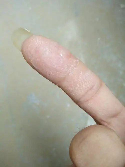 快一个月了,脱皮不能复原!皮下面有很多像