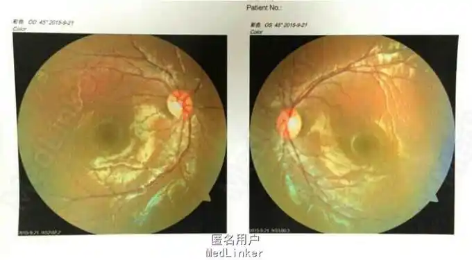 视锥视杆细胞营养不良一例