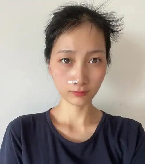 那时候都不敢洗头,额头鬓角两边整个都是秃掉的,极丑,不敢出门,家里买