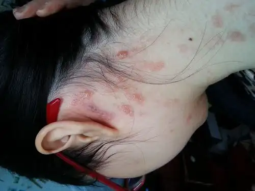 颈部红斑狼疮图片