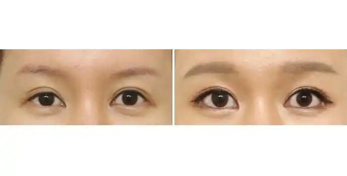 开外眼角前后对比图开外眼角效果图开外眼角前后对比照片