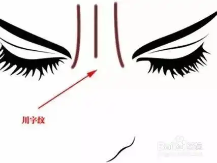 后脑勺有川字纹得怎么去除