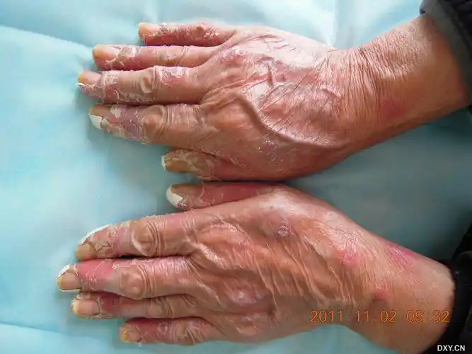 违规侵权,站友争执 附件异常,链接失效 其他 北京确认接诊2名鼠疫