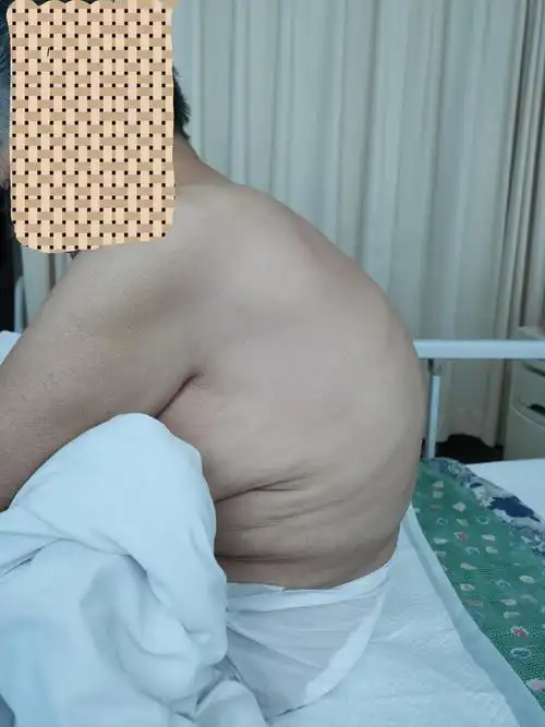 我院首例脊柱pso截骨矫形 骨水泥强化螺钉固定治疗高龄脊柱后凸患者