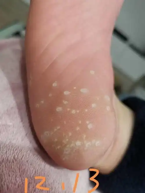 最简单的跖疣治疗方法,没有之一 !简直比冷冻好太多了 - 知乎