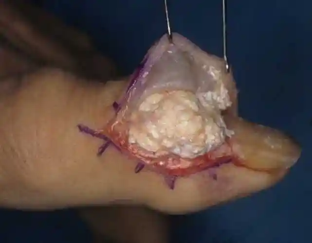 这些石膏的形成,都离不开一个根本原因:各种病因引起的高尿酸血症