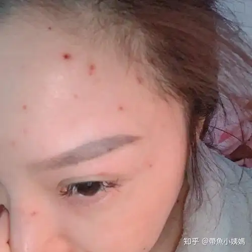 水痘的心得 - 知乎