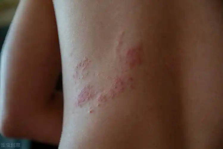 蛇盘疮怎么治疗,飞蛇疮民间治疗偏方-爱妻自媒体