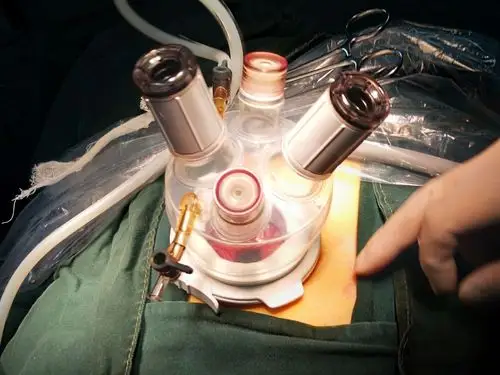 祝贺黑龙江省铁力市医院李国彬主任中国首例lagiport微易通单孔腹腔镜