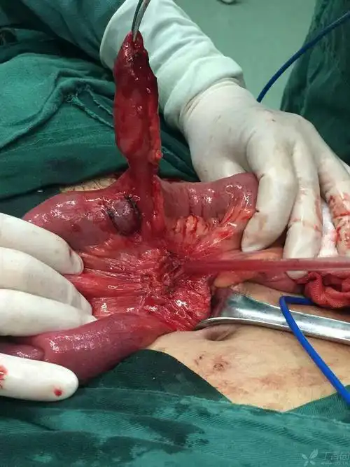 【病例讨论】(小肠憩室)已经手术证实,大家一起来学习吧 [病例帖]