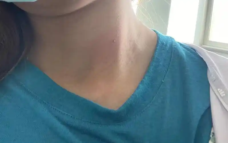 6楼9号房间做冷喷冷喷很快,有点疼,做完2-4周回来复查#皮赘  #丝状疣