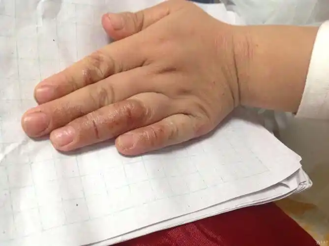 小儿手部顽固皮肤病. - 皮肤及性传播疾病讨论版 - 爱爱医医学论坛
